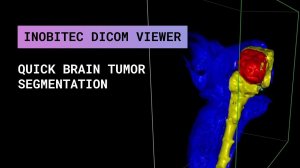 Быстрая сегментация опухоли мозга в Inobitec DICOM Viewer Pro. Ветеринария