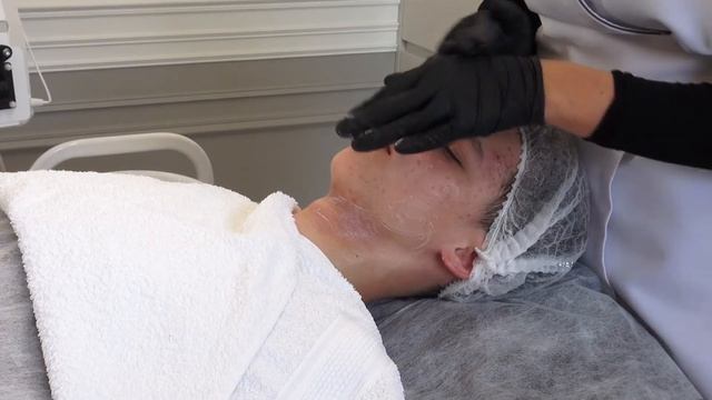 AKNĖS  Gydymo Procedūra Su RENOPHASE LABORATOIRES.