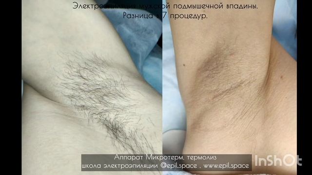 Электроэпиляция. Избавление от волос навсегда. Результат процедур - мужские подмышечные впадины. смотреть онлайн