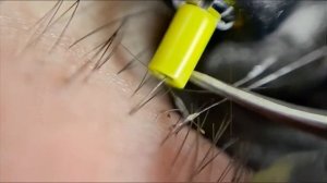 Удаление вросших волос. Чёрные точки. Blackhead