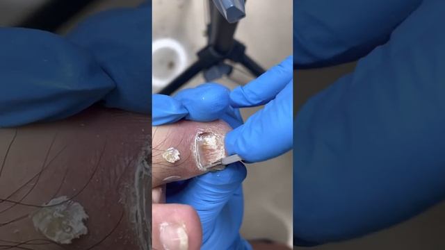 Hard and thick toenails 【pedicure master Lin Jun】 смотреть онлайн