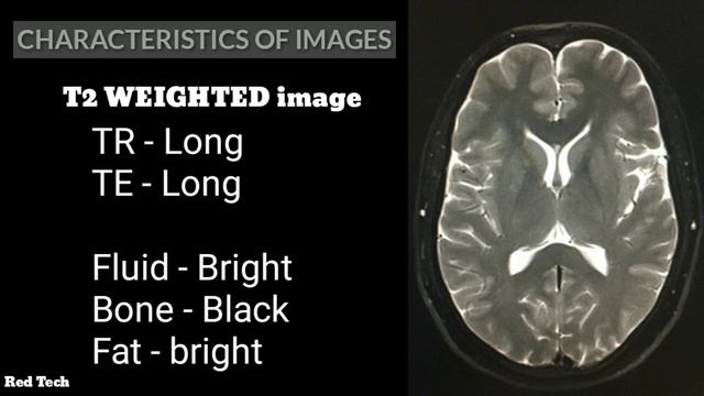 MRI || T2 Vs T1 WEIGHTED IMAGE || HINDI ||