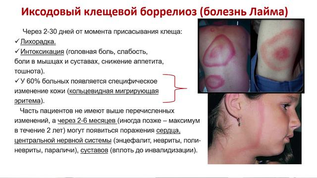 Медики для немедиков: что делать, если укусил клещ смотреть онлайн