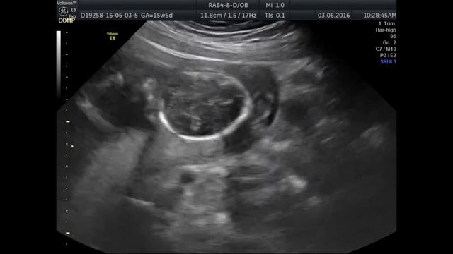 клапан задней уретры смотреть онлайн