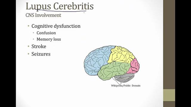 Systemic Lupus Erythematosis смотреть онлайн