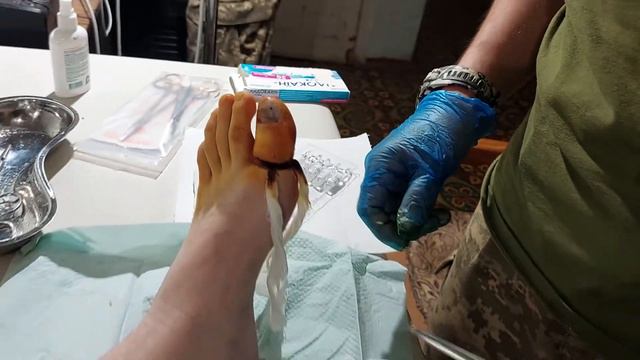 Оніхокріптоз - операція смотреть онлайн