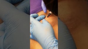 Электроэпиляция обучение