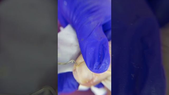 удаление подногтевой мозоли #подологалексин смотреть онлайн