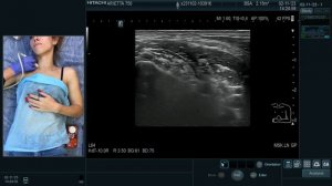 МК ИССЛЕДОВАНИЕ ПЛЕЧЕВОГО СПЛЕТЕНИЯ. САЛТЫКОВА В.Г.