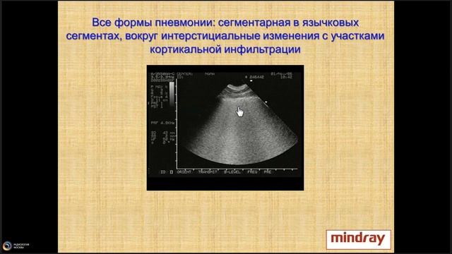 Ультразвуковая семиотика и дифференциальная диагностика пневмоний смотреть онлайн