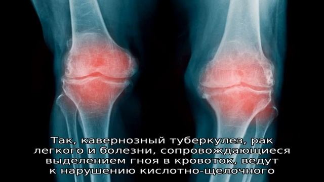Артропатия суставов