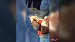 Ампутация голени с иссечением камбаловидной мышцы