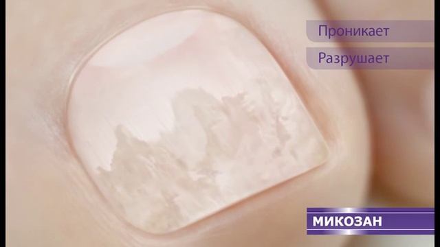 Микозан - видимая победа над грибком ногтей!
