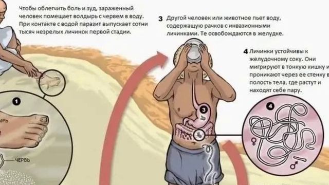 Дракункулез: жизненный цикл ришты смотреть онлайн