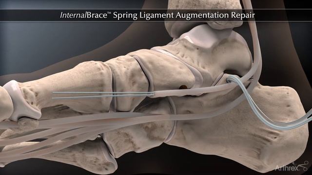 InternalBrace™ Spring Ligament Augmentation Repair смотреть онлайн