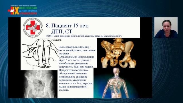 Сложные вопросы диагностики и лечения скелетной травмы в структуре политравмы у детей смотреть онлайн