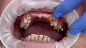 Мостовидный металлокерамический протез