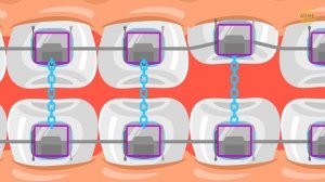 Как работают брекеты (и почему так медленно)