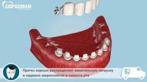 Бюгельные протезы: бюгельный протез с ригельным замком