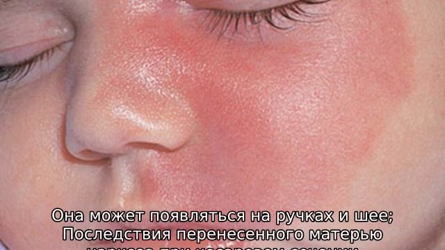 Красные пятна на лице у новорожденного ребенка смотреть онлайн