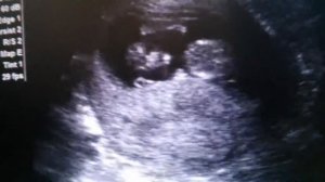 Узи 12 недель