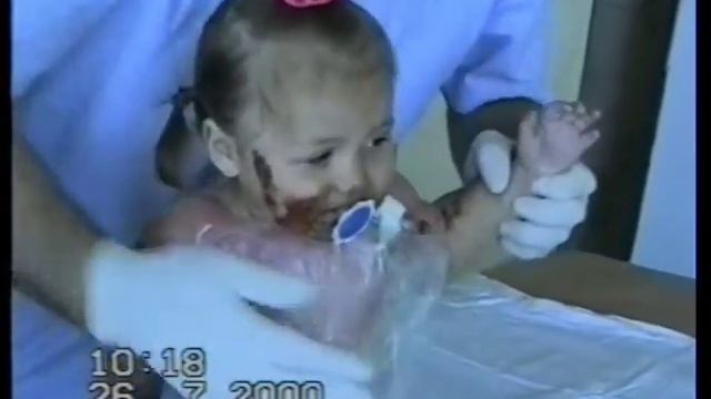 Лечение ожогов у детей смотреть онлайн