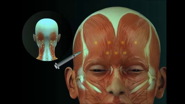 Botox Injections For Migraine Headaches