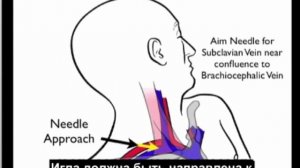 Порядок выполнения: надключичный доступ для катетеризации подключичной вены