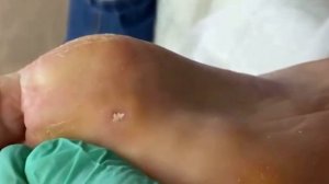 Убираем стержневую мозоль⚠️❗️??