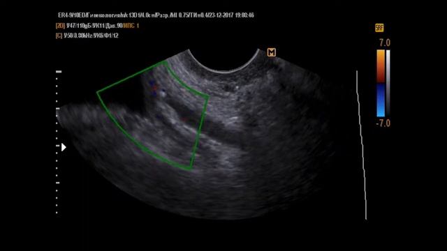 Конкремент н/3 мочеточника ТА+ТВ