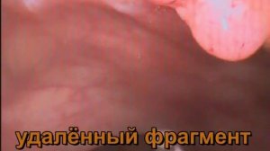 Ворсинчатая опухоль прямой кишки. Рецидив.