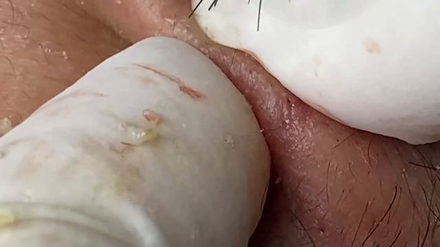 Acne Treatment With Sac Dep Spa #03 смотреть онлайн