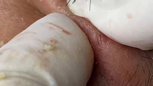 Acne Treatment With Sac Dep Spa #03