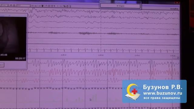 Диагностика синдрома обструктивного апноэ сна с помощью полисомнографии смотреть онлайн