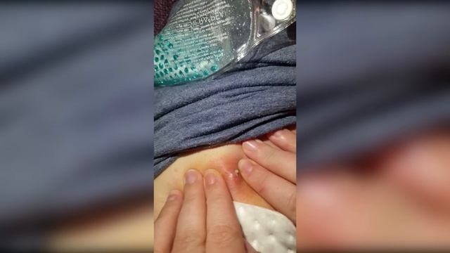 Popping huge blackheads and Pimple Popping - Best Pimple Popping Videos #2 смотреть онлайн