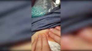 Popping huge blackheads and Pimple Popping - Best Pimple Popping Videos #2