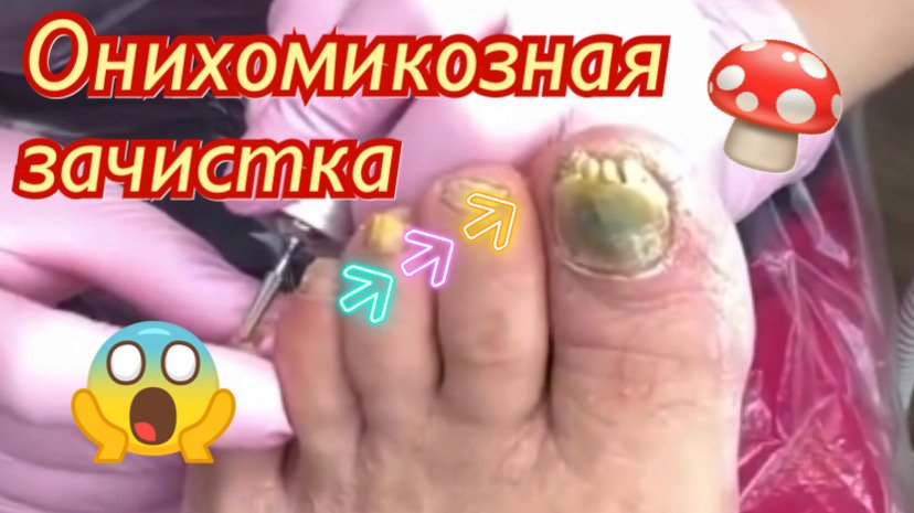 Онихомикозная зачистка???⚠️?