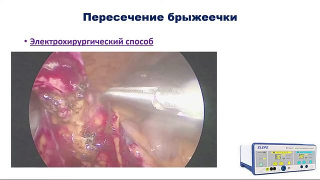 Лапароскопическая аппендэктомия смотреть онлайн