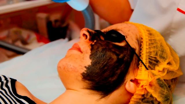 Карбоновый пилинг / Спа салон Алматы Beauty Cafe | www.beauty-cafe.kz смотреть онлайн