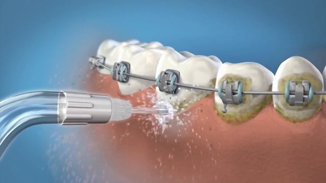 รีวิว เครื่องฉีดน้ำแรงดันสำหรับคนจัดฟัน water flosser смотреть онлайн