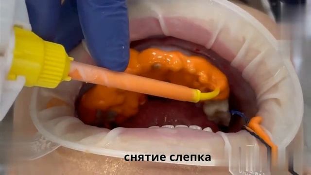 Этапы изготовления циркониевой коронки смотреть онлайн