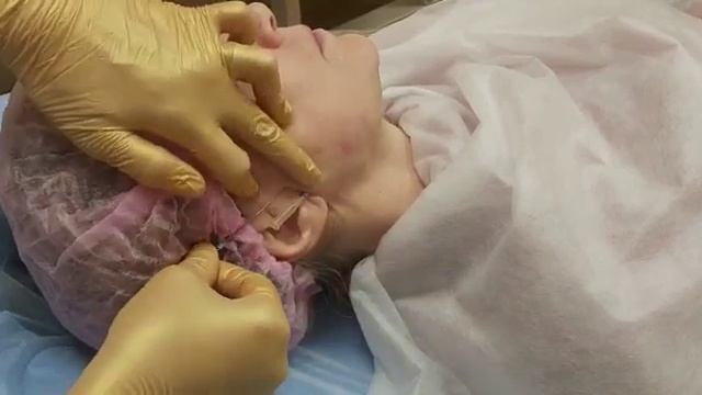 АирисКом студенты учатся: установка мезонитей Cog нижняя часть лица.