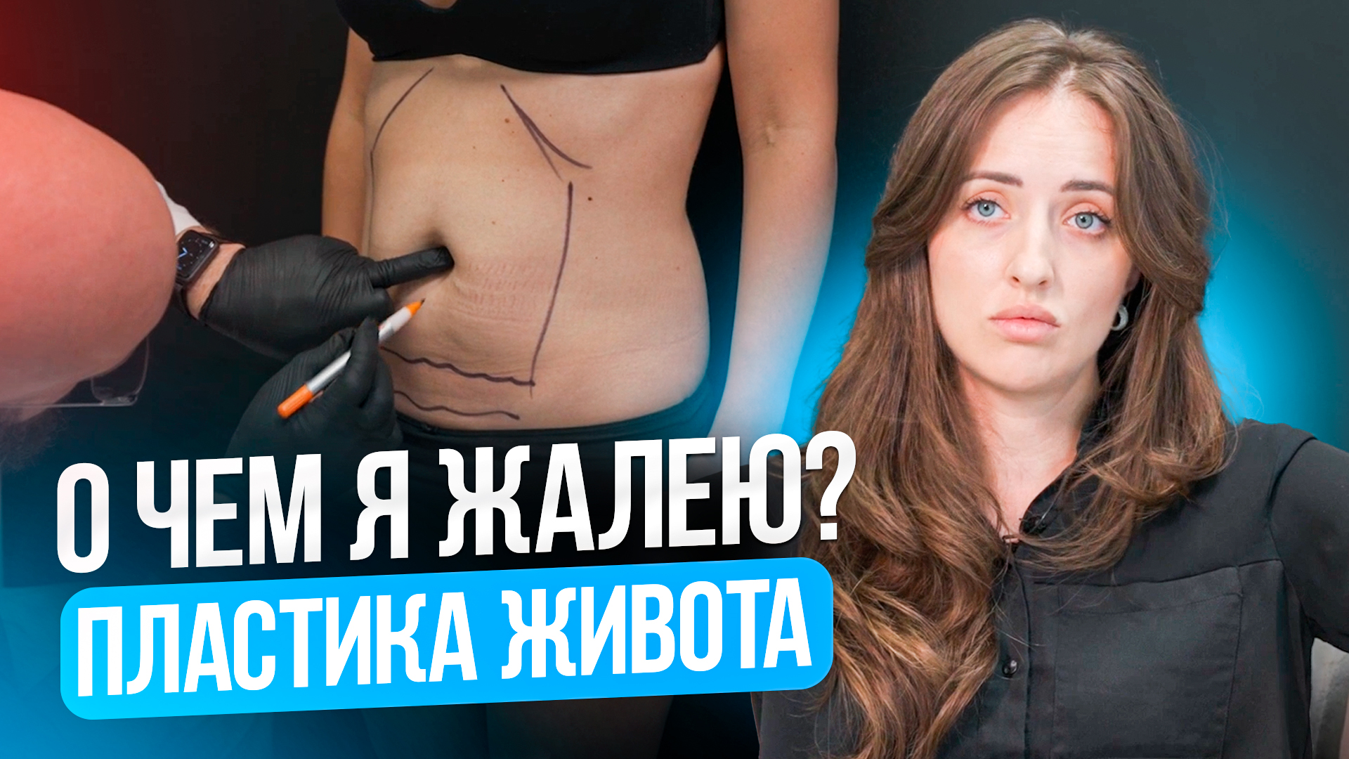 Пластика живота после родов. Как сохранить красивый живот. Ушивание диастаза через пупочную ямку смотреть онлайн