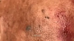 Removes acne - Давим прыщи, чёрные точки. Залипательно 2021
