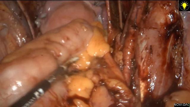 laparoscopic pelvic lymph node dissection смотреть онлайн