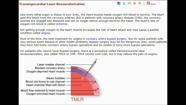 Transmyocardial Laser Revascularization (TMLR) in ICD-10-PCS: Cardiovascular Procedure Coding смотреть онлайн