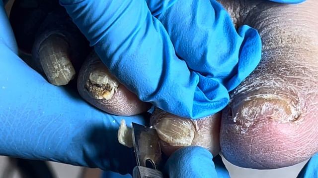 All are broken nail fungus, a lot of dead skin like crocodile skin【Pedicure Master Lin Jun】 смотреть онлайн