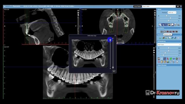 Использование панорамного модуля для диагностики КЛКТ в Planmeca Romexis смотреть онлайн