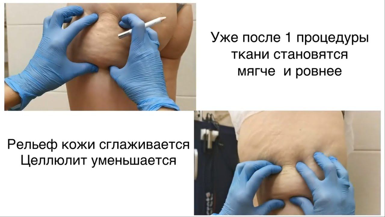 Удаление жировых 