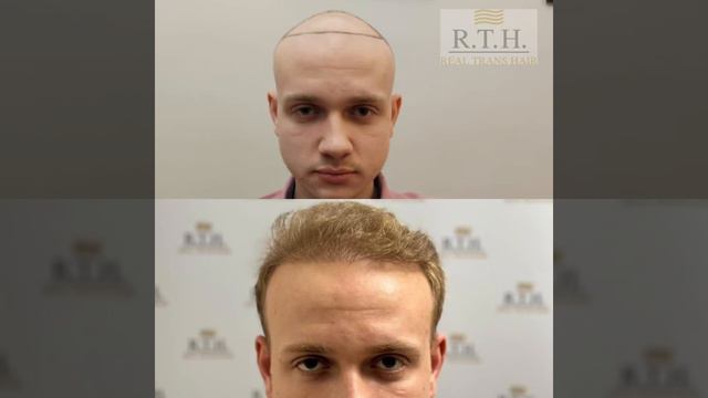 До и После пересадки волос смотреть онлайн